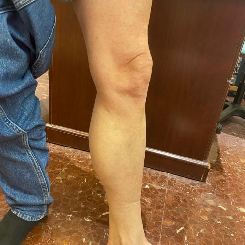 eliminacion-de-varices-despues-2